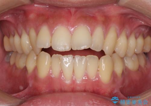 隙間が空いて突出した前歯を治したい　ワイヤー装置による抜歯矯正の症例 治療前