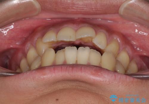 隙間が空いて突出した前歯を治したい ワイヤー装置による抜歯矯正の治療前