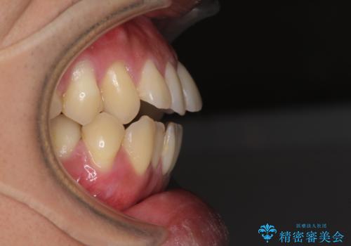 隙間が空いて突出した前歯を治したい ワイヤー装置による抜歯矯正の治療前