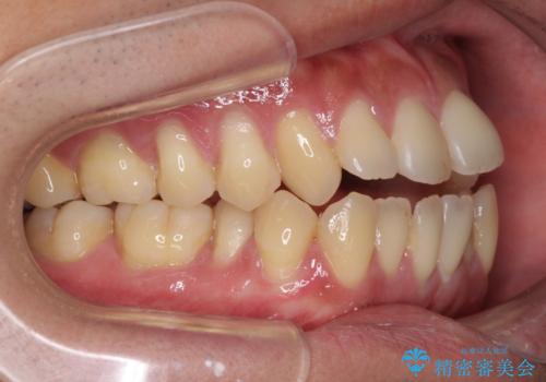 隙間が空いて突出した前歯を治した　ワイヤー装置による抜歯矯正の治療前