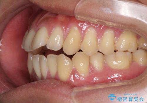 隙間が空いて突出した前歯を治したい ワイヤー装置による抜歯矯正の治療前