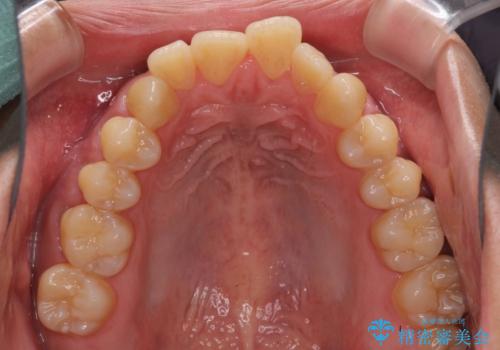 隙間が空いて突出した前歯を治したい ワイヤー装置による抜歯矯正の治療前