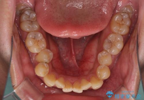 隙間が空いて突出した前歯を治したい ワイヤー装置による抜歯矯正の治療前
