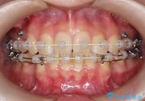 ワイヤーによる抜歯矯正でガタガタの改善の治療中