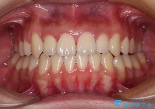 急速拡大装置 狭い上顎骨を拡大してワイヤー装置で短期間治療の治療後