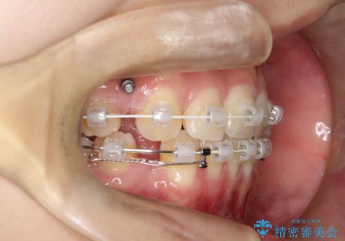 ワイヤーによる抜歯矯正でガタガタの改善の治療中