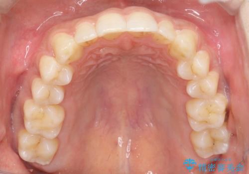 前歯のデコボコした歯並びをマウスピースで改善!の治療後