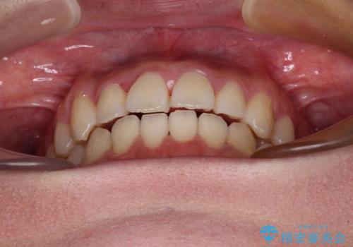 急速拡大装置 狭い上顎骨を拡大してワイヤー装置で短期間治療の治療後