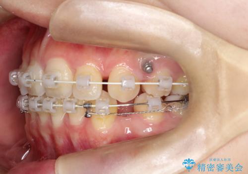 ワイヤーによる抜歯矯正でガタガタの改善の治療中