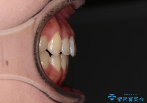 急速拡大装置　狭い上顎骨を拡大してワイヤー装置で短期間治療の治療後