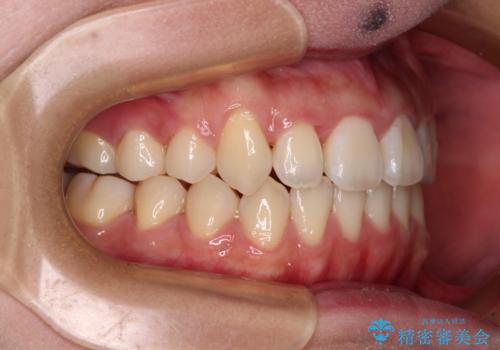 急速拡大装置 狭い上顎骨を拡大してワイヤー装置で短期間治療の治療後