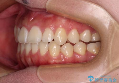 急速拡大装置 狭い上顎骨を拡大してワイヤー装置で短期間治療の治療後