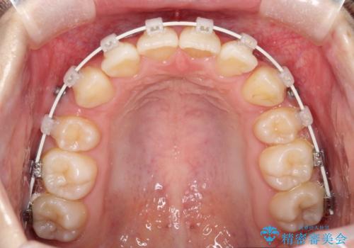 ワイヤーによる抜歯矯正でガタガタの改善の治療中