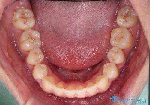 急速拡大装置 狭い上顎骨を拡大してワイヤー装置で短期間治療の治療後