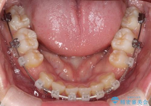 ワイヤーによる抜歯矯正でガタガタの改善の治療中