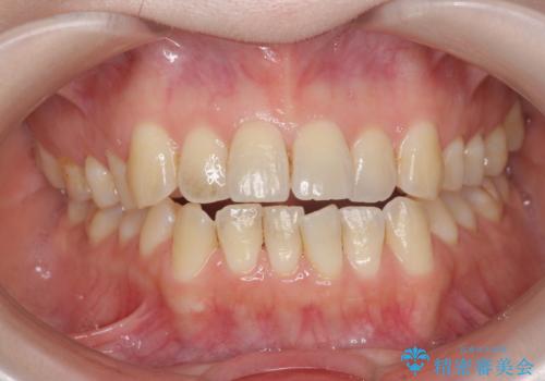 オフィスホワイトニングで白く透明感のある歯に!!の症例 治療前