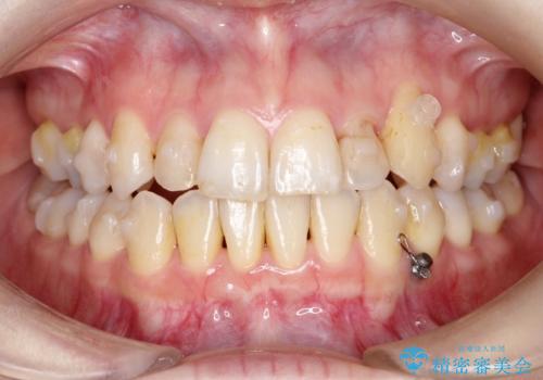 飛び出した八重歯が気になる!非抜歯でマウスピース(インビザライン)による治療症例の治療中