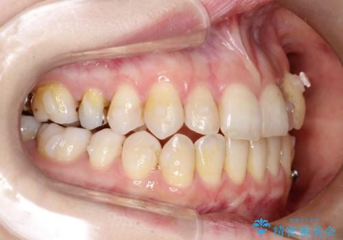 飛び出した八重歯が気になる!非抜歯でマウスピース(インビザライン)による治療症例の治療中