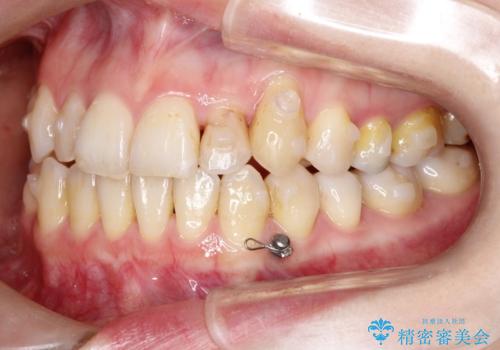 飛び出した八重歯が気になる!非抜歯でマウスピース(インビザライン)による治療症例の治療中