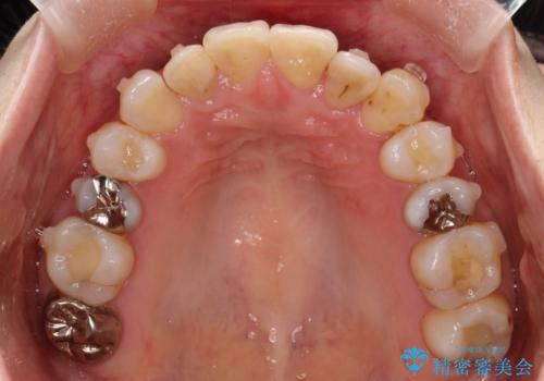 飛び出した八重歯が気になる!非抜歯でマウスピース(インビザライン)による治療症例の治療中