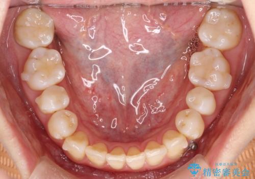 飛び出した八重歯が気になる!非抜歯でマウスピース(インビザライン)による治療症例の治療中