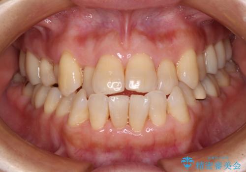 銀歯を白くしたい　セラミックによる審美歯科治療