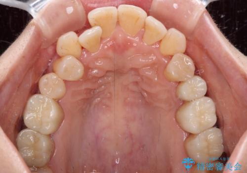 銀歯を白くしたい セラミックによる審美歯科治療の治療後