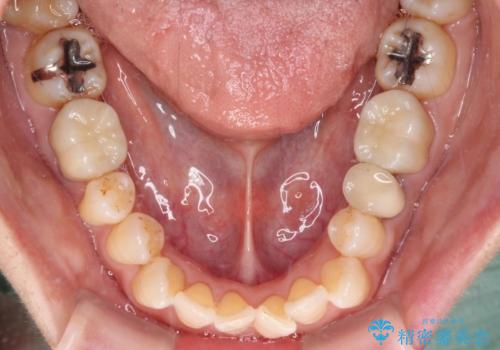 銀歯を白くしたい セラミックによる審美歯科治療の治療後