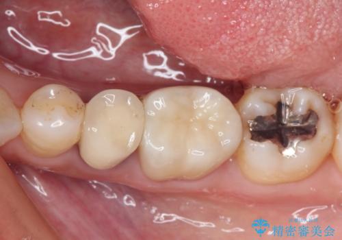 銀歯を白くしたい セラミックによる審美歯科治療の治療後