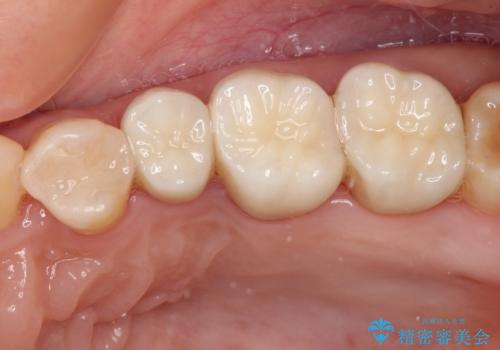 銀歯を白くしたい セラミックによる審美歯科治療の治療後