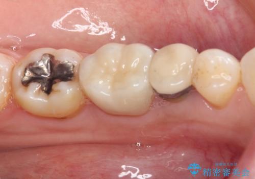 銀歯を白くしたい セラミックによる審美歯科治療の治療後
