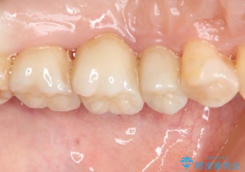 銀歯を白くしたい セラミックによる審美歯科治療の治療後