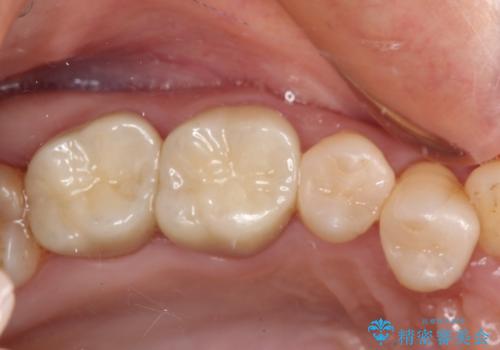 銀歯を白くしたい セラミックによる審美歯科治療の治療後