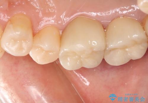銀歯を白くしたい セラミックによる審美歯科治療の治療後