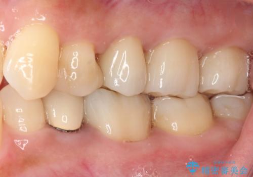 銀歯を白くしたい　セラミックによる審美歯科治療の治療後