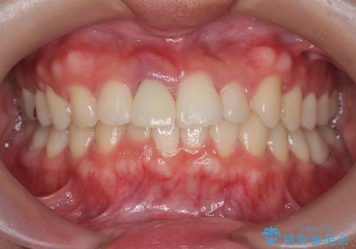 オフィスホワイトニング(被せ物を作る前に自分の歯を白く)の症例 治療前
