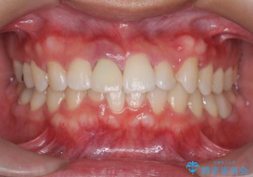 オフィスホワイトニング(被せ物を作る前に自分の歯を白く)の症例 治療後