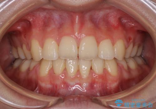 ワイヤーによる抜歯矯正でガタガタの改善の症例 治療後