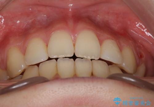 ワイヤーによる抜歯矯正でガタガタの改善の治療後