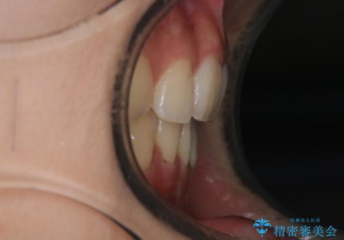 ワイヤーによる抜歯矯正でガタガタの改善の治療後