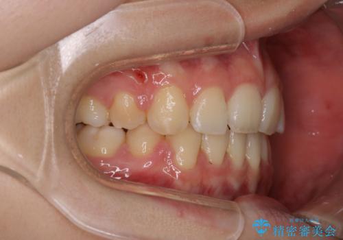 ワイヤーによる抜歯矯正でガタガタの改善の治療後