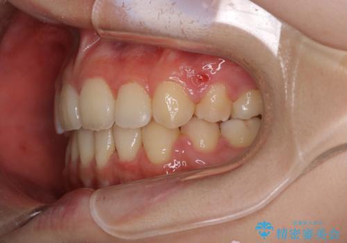 ワイヤーによる抜歯矯正でガタガタの改善の治療後