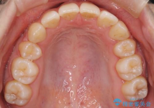 ワイヤーによる抜歯矯正でガタガタの改善の治療後
