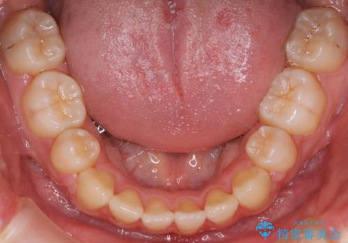 ワイヤーによる抜歯矯正でガタガタの改善の治療後