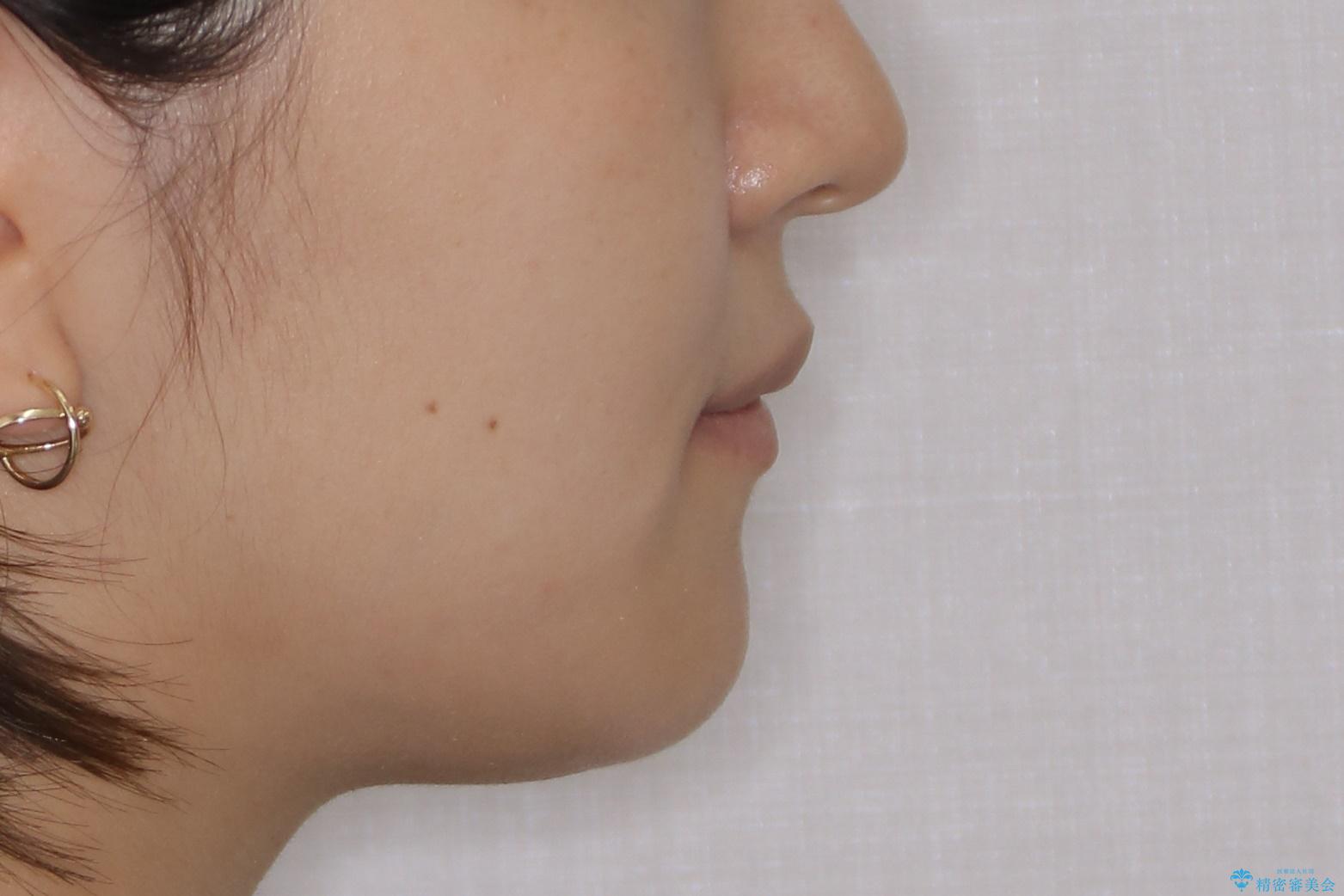 ワイヤーによる抜歯矯正でガタガタの改善の治療後(顔貌)