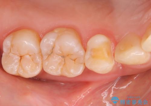 矯正終了し、銀歯が見えるため治してほしい。セラミック治療の治療中