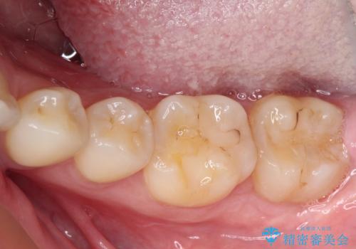 左下の奥歯が冷たいものがしみてザラザラする　ゴールドインレー修復　の症例 治療前