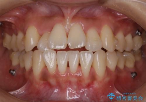 【非抜歯】左右の八重歯・前歯の反対咬合の改善 インビザラインの治療中