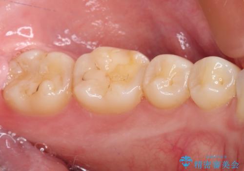 左下の奥歯が冷たいものがしみてザラザラする ゴールドインレー修復 の治療前