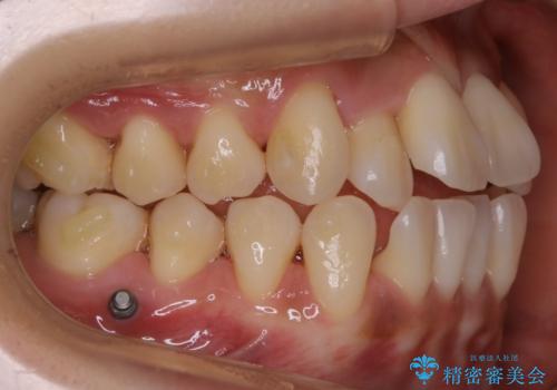 【非抜歯】左右の八重歯・前歯の反対咬合の改善 インビザラインの治療中
